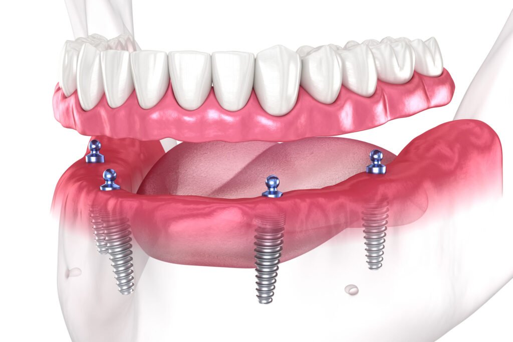 Understanding Dental Implants