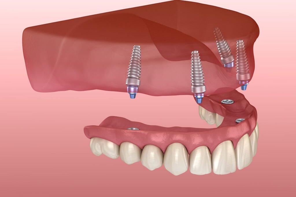 Types of Dental Implants