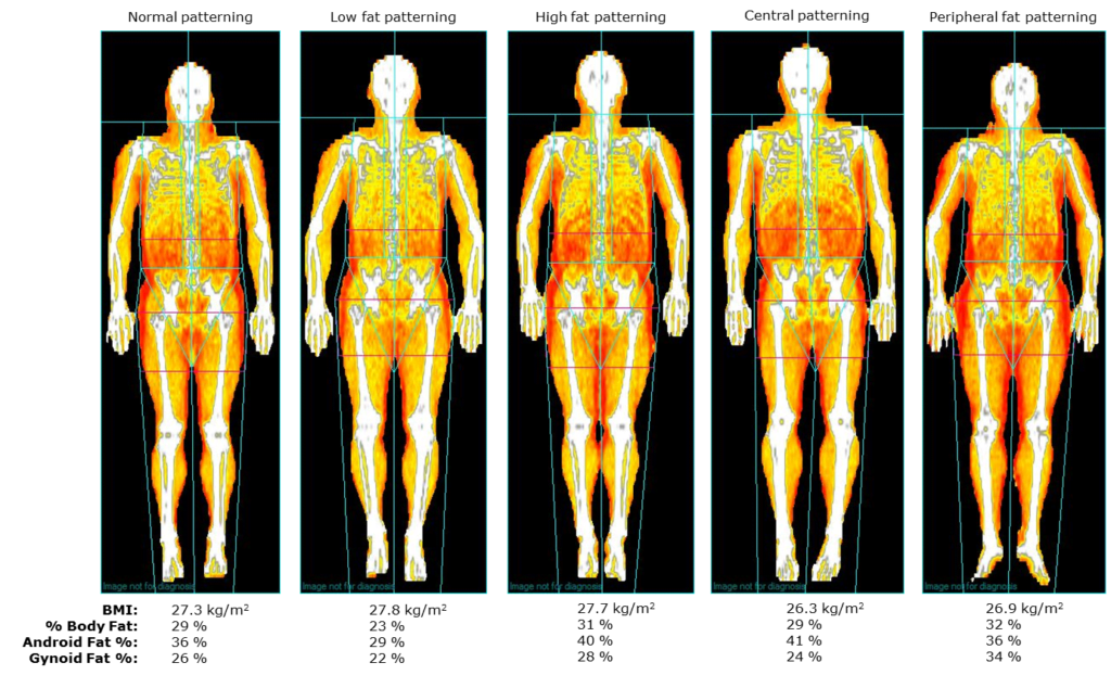 DEXA Scans